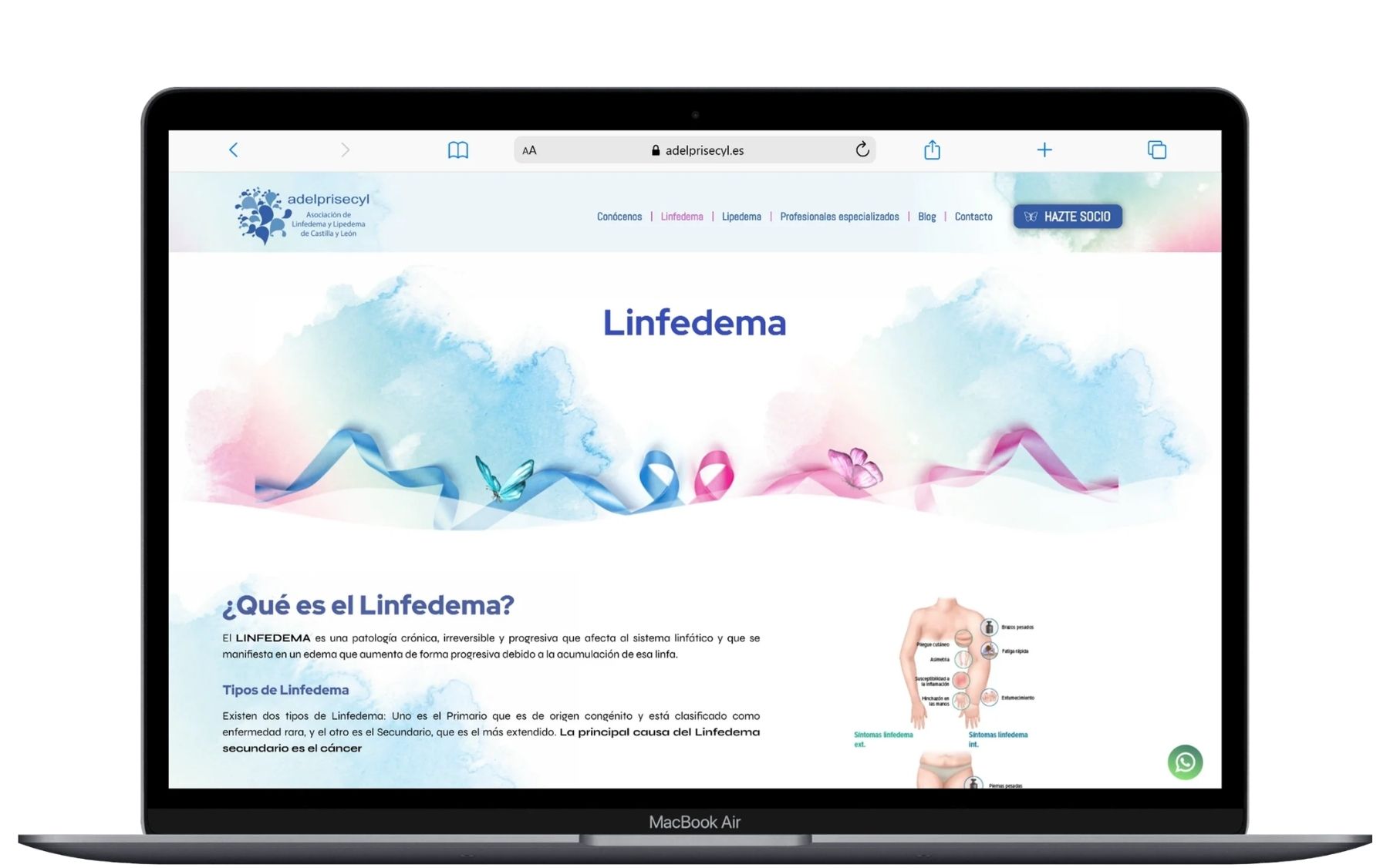 Adelprisecyl_Linfedema