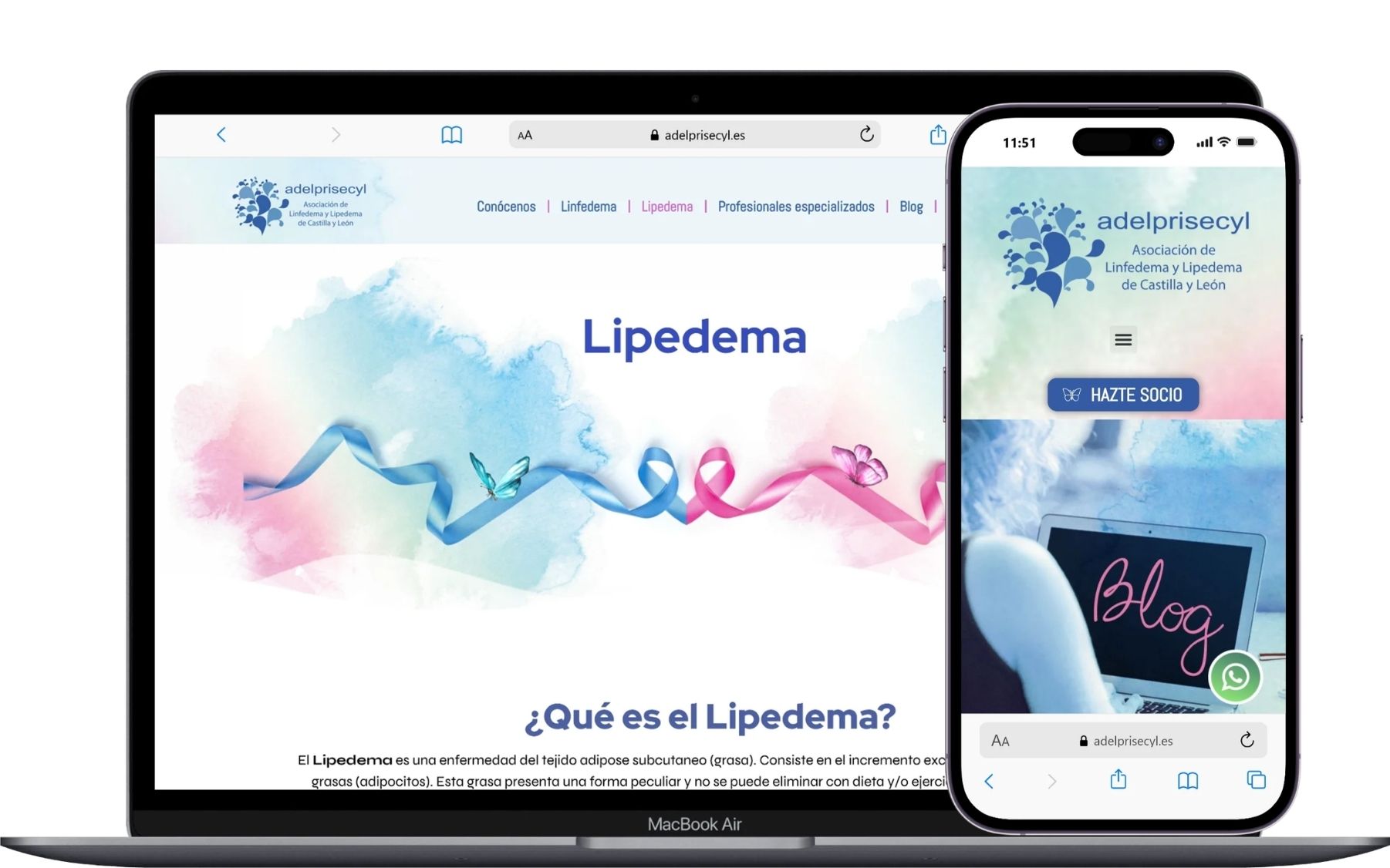 Adelprisecyl_Lipedema+Blog